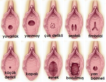 Kızlık Zarı Dikme Operasyonu